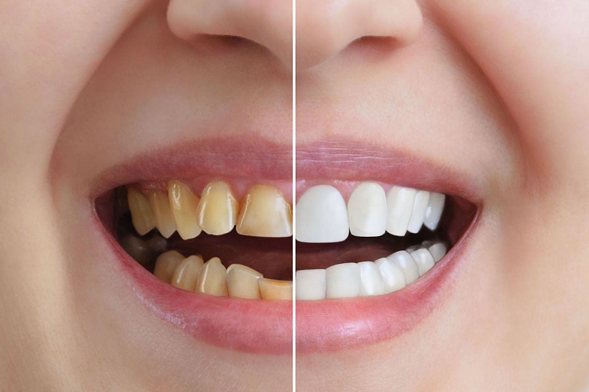 Blanqueamiento en casa vs en clínica: ¿cuál elegir?