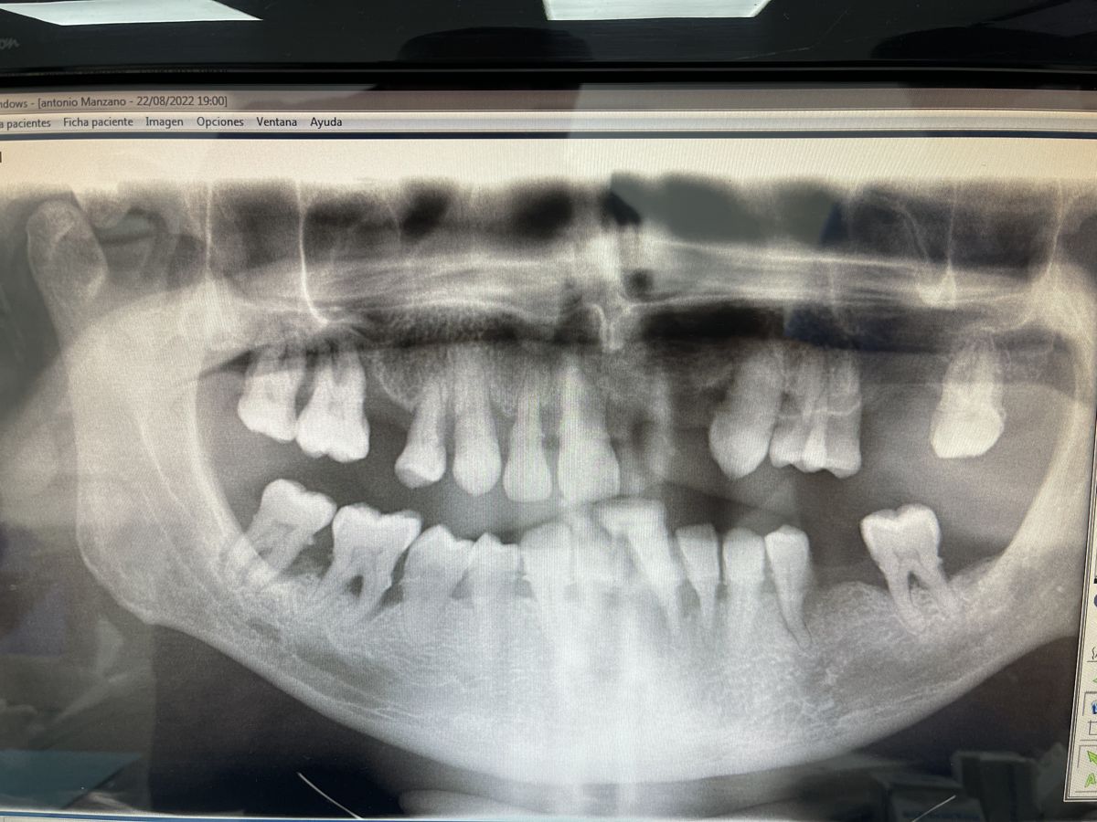 ¿Cada cuánto hacerse una limpieza dental?