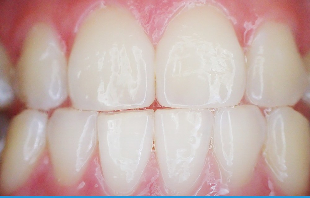 ¿Las carillas dañan los dientes? Mitos y realidad