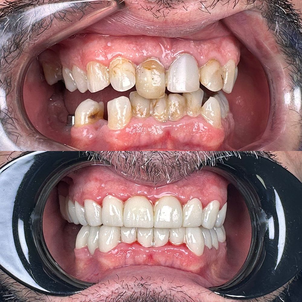 Carillas de porcelana o composite: ¿cuál elegir?