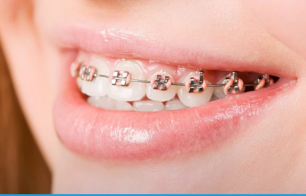 ¿Cuánto dura un tratamiento de Invisalign?