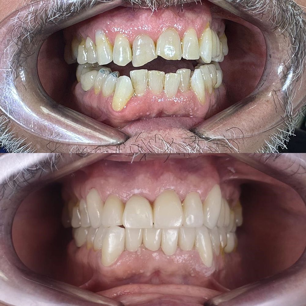 Dientes apiñados: causas y solución