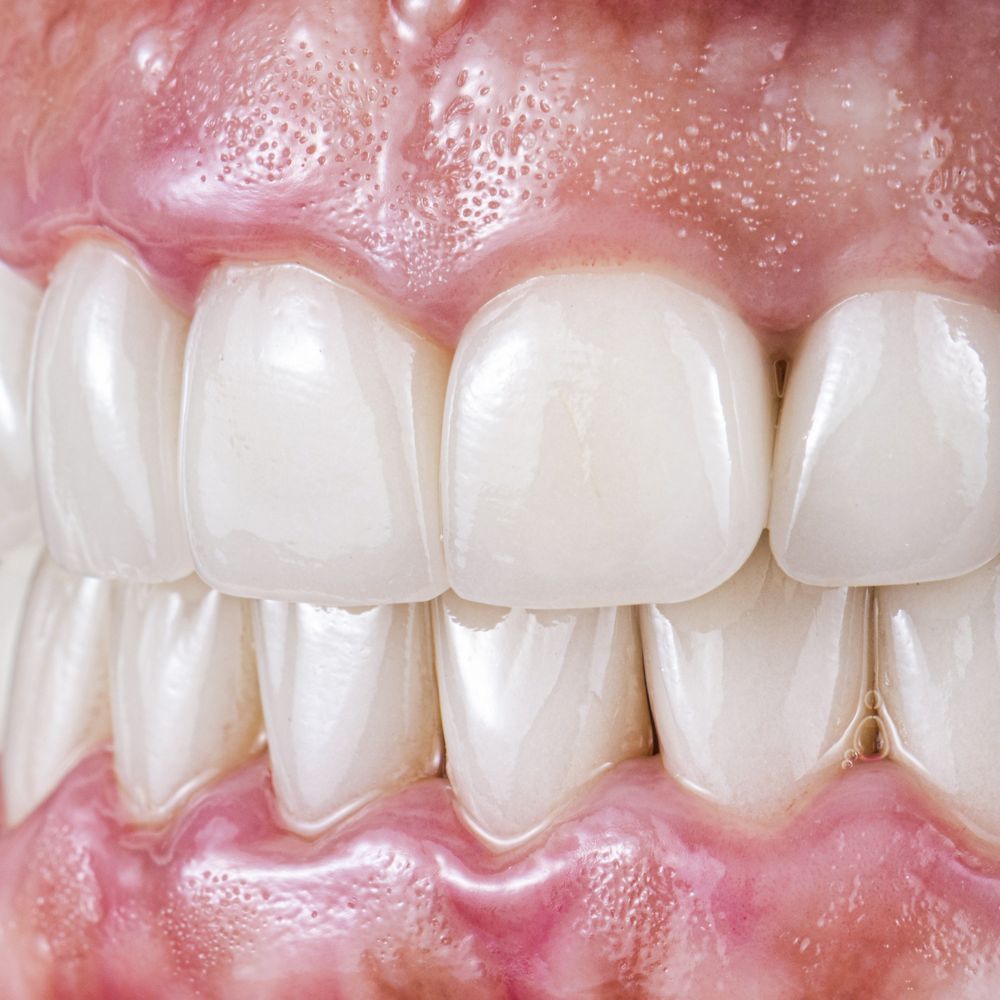 ¿Empaste o endodoncia? Qué necesita tu caries