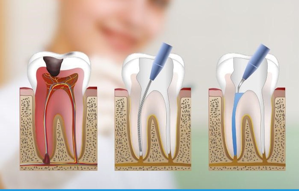 Encías que sangran: gingivitis y cómo frenarla