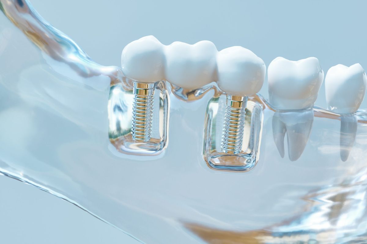 precio implantes dentales carabanchel