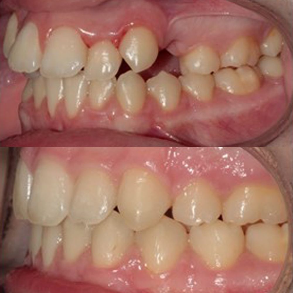 Tipos de brackets: metálicos, estéticos y linguales