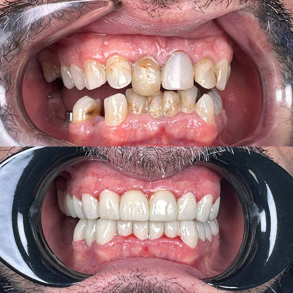 Antes y después de rehabilitación dental completa en Carabanchel