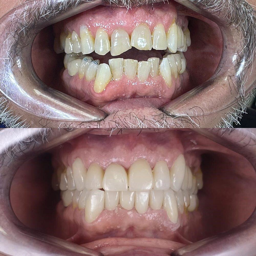 Antes y después de rehabilitación estética de dientes desgastados en Carabanchel