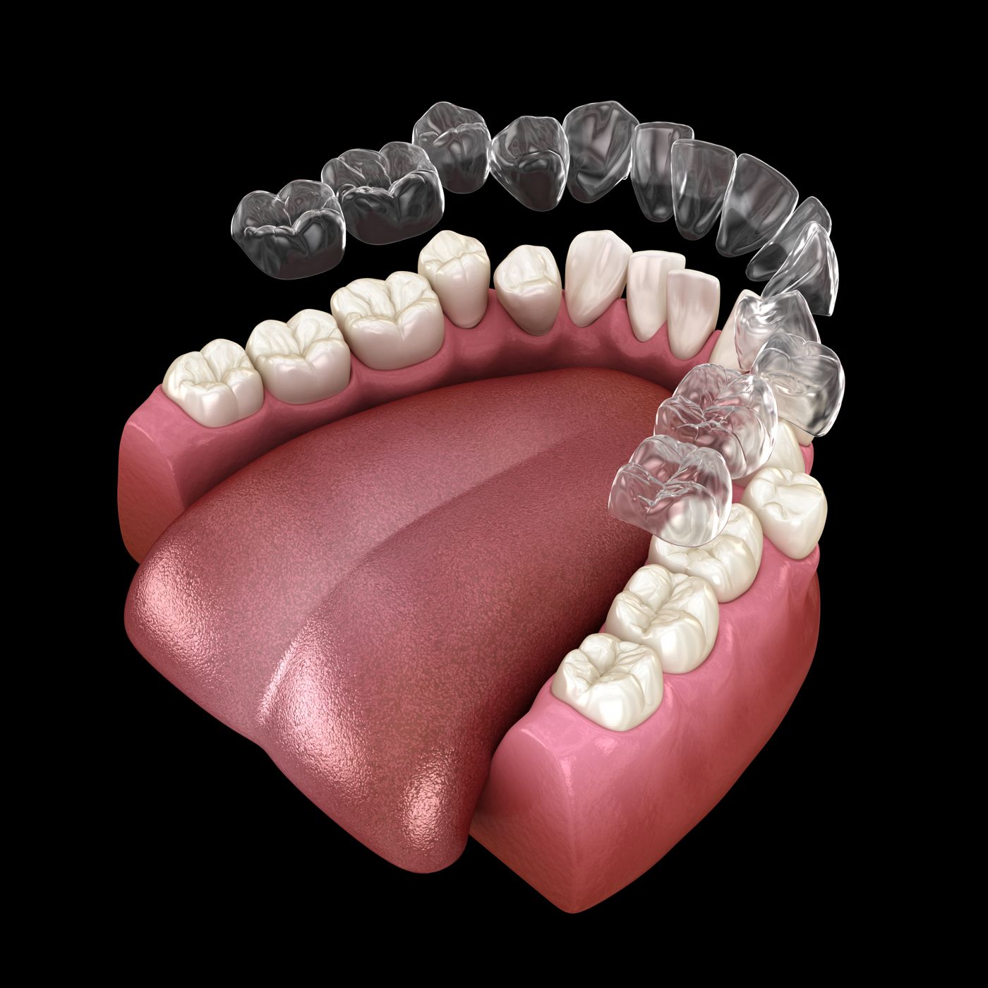Alineador Invisalign para ortodoncia invisible en Carabanchel